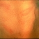 Lyme Disease
